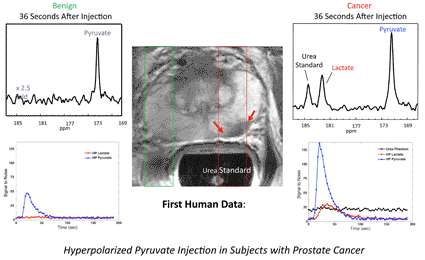 Image: First Human Data: Hyperpolarized Pyruvate Injection in Subjects with Prostate Cancer (Photo courtesy University of California, San Francisco / GE Healthcare). Image: First Human Data: Hyperpolarized Pyruvate Injection in Subjects with Prostate Cancer (Photo courtesy University of California, San Francisco / GE Healthcare).